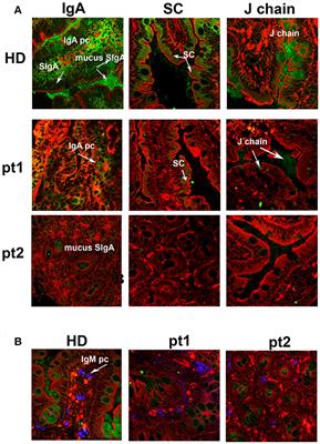 Lack of Gut Secretory Immunoglobulin A in Memory B-Cell Dysfunction-Associated Disorders: A Possible Gut-Spleen Axis